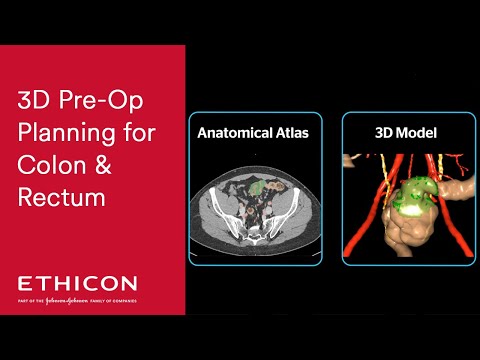 How 3D Pre-Operative Planning Works with VISIBLE PATIENT - Colon & Rectum | Ethicon