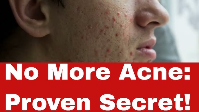 Say Goodbye To Acne Expert Tips For Clear 2024