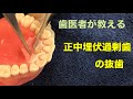 上顎正中過剰歯（埋伏型）の抜歯