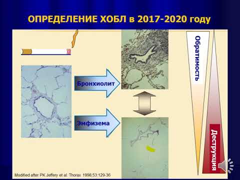 6 курс ЛФ. Лекция на тему: "ХОБЛ"