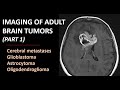 Imaging of brain tumors part 1 metastases glioblastoma and beyond