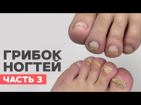 Без шансов | Отказал подолог | Грибок ногтей на ногах