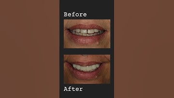 Smileology - Case Reveal - Invisalign & Composite Bonding