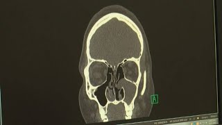 3D sinus surgery