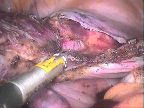 TLH-TOTAL LAPAROSCOPIC HYSTERECTOMY WITH BIPOLAR