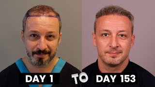 HAIR TRANSPLANT TIMELAPSE | DAY 1 TO DAY 153 | GROWTH IN 5 MONTHS |  BEFORE & AFTER