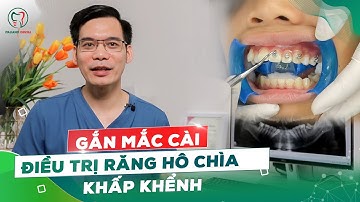 Gắn Mắc Cài Điều Trị Răng Hô Chìa Khấp Khểnh tại Nha Khoa Italiano. #nhakhoathainguyen #xuhuong