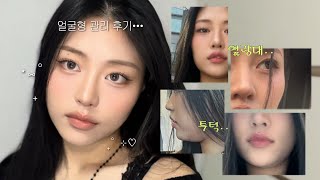 옆광대•투턱 부자의 얼굴형 관리 후기② 광대축소주사, 소개팅주사,윤곽주사