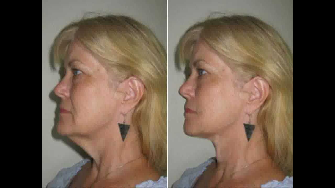 how to get rid of double chin without surgery and start