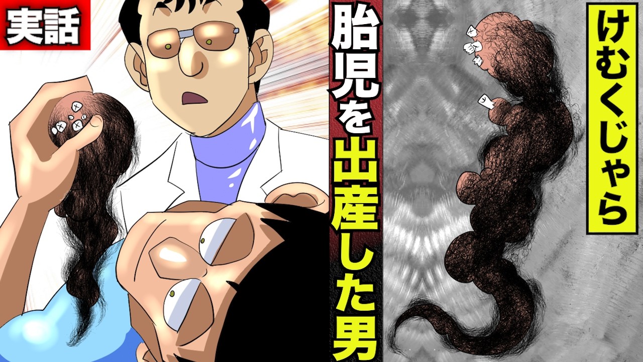 【実話】胎児を出産した男…医師も絶句。