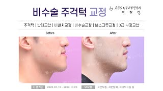 비수술주걱턱교정(주걱턱/반대교합/비발치교정/비수술교정/본스크류교정/3급부정교합) B&amp;A :: 부산수영해운대교정치과-뉴욕스마일교정치과
