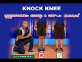 HOW TO SOLVE KNOCK KNEE PROBLEM FOR MEDICAL IN ARMY  /KNOCK KNEE CORRECTION EXERCISE IN MALAYALAM