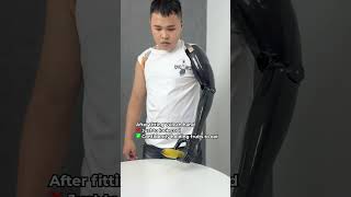 Eating fruits with Transhumeral Hand #prosthetics #orthotics #bionic #inspire  #healthtech