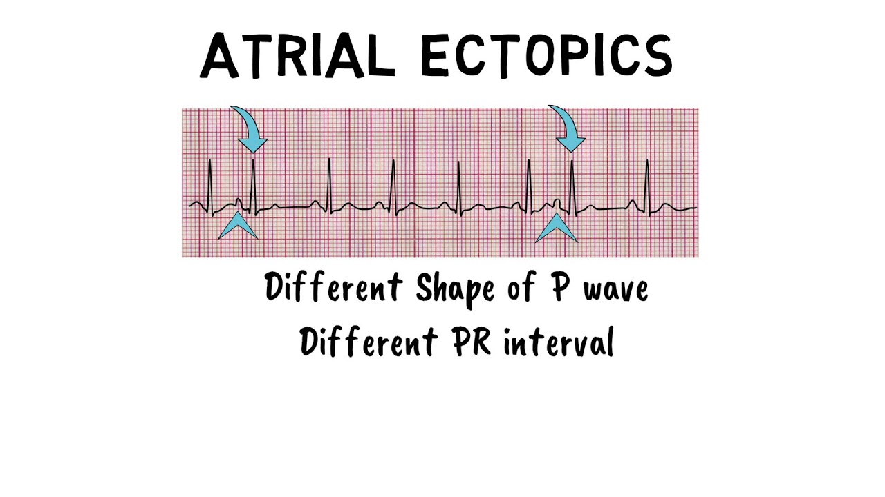 Phenytoin as related to Ectopic heartbeat - Pictures