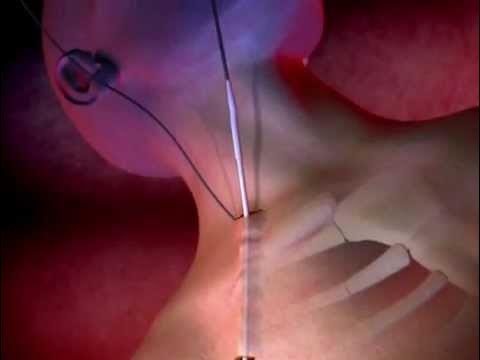 Outline Video ProGuide™ Chronic Dialysis Catheters Animation
