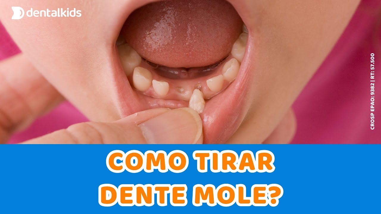 Como tirar DENTE MOLE? | ODONTOPEDIATRIA | dentalkids - YouTube