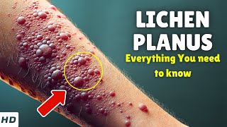 Lichen Planus Explained: Causes, Signs & Symptoms & How to Treat It FAST!