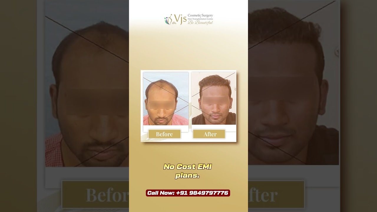 Transform Your Hair at the Best Hair Clinic in India – VJ’s Clinics
