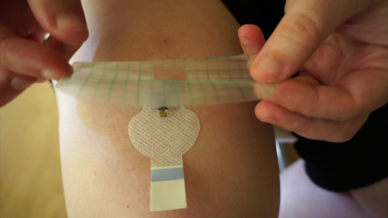 Inserción sensor glucemia de Medtronic