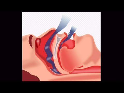 Видео: Може ли кислородният концентратор да се използва за сънна апнея?