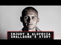 SMALLBONE'S STORY | Southampton youngster Will Smallbone on overcoming injury and alopecia