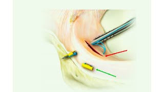 Meniscal Repair: Getting It Right First Time