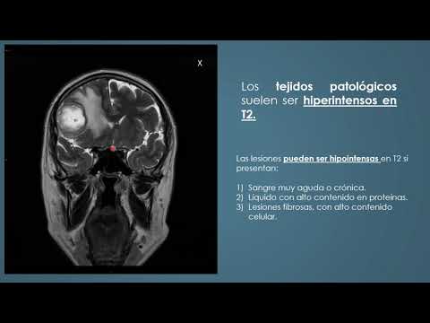 Video: Secuencias en resonancia magnética