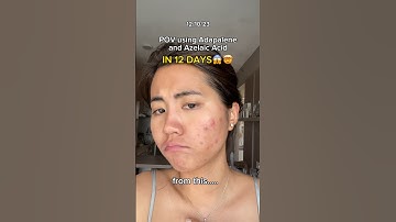 Adapalene + Azelaic Acid Miracle Combo in 12 Days😍