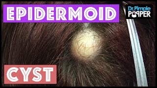 Find Out What Kind of Cyst is being Excised.. Pilar or Epidermoid?