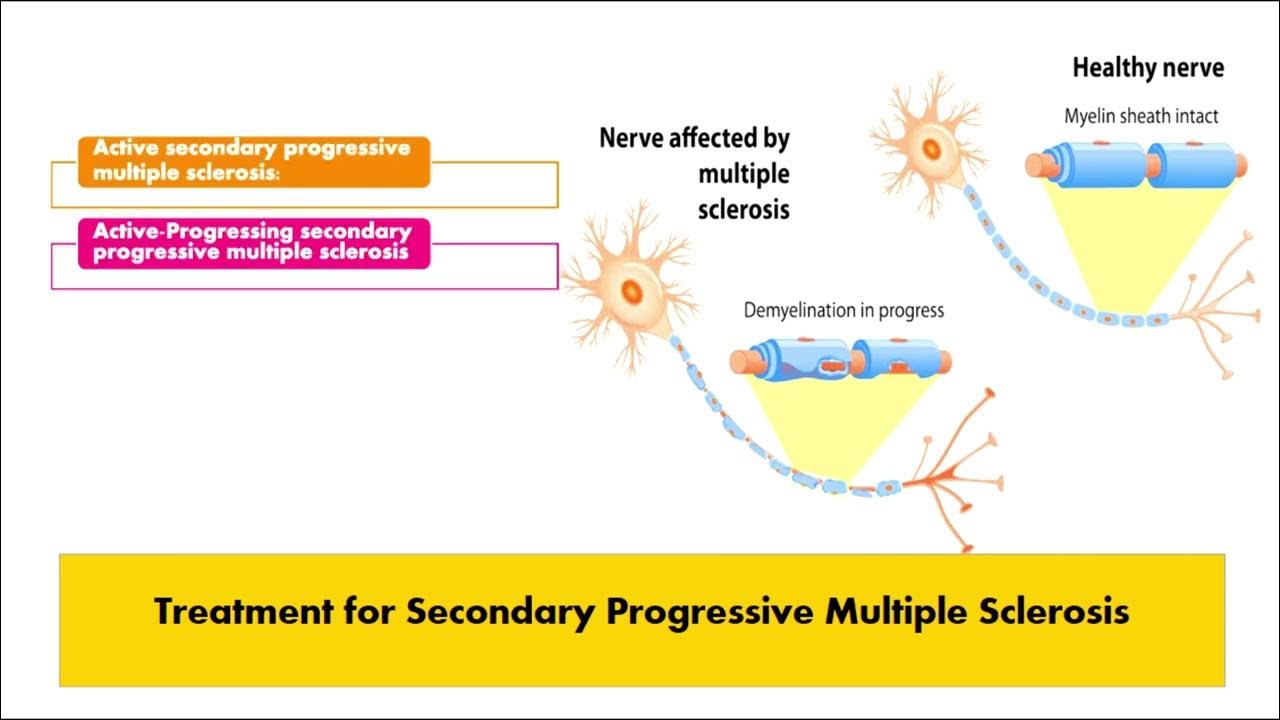 Treatment for Secondary Progressive multiple sclerosis YouTube
