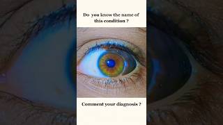 Serious Diagnosis condition 😱#eyes #eyecareprofessional #optometrist #eyespecialist #eyediseases
