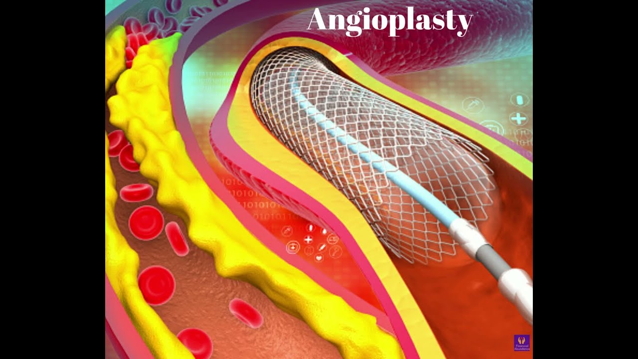 How to Claim your Angioplasty Critical Illness Benefit?