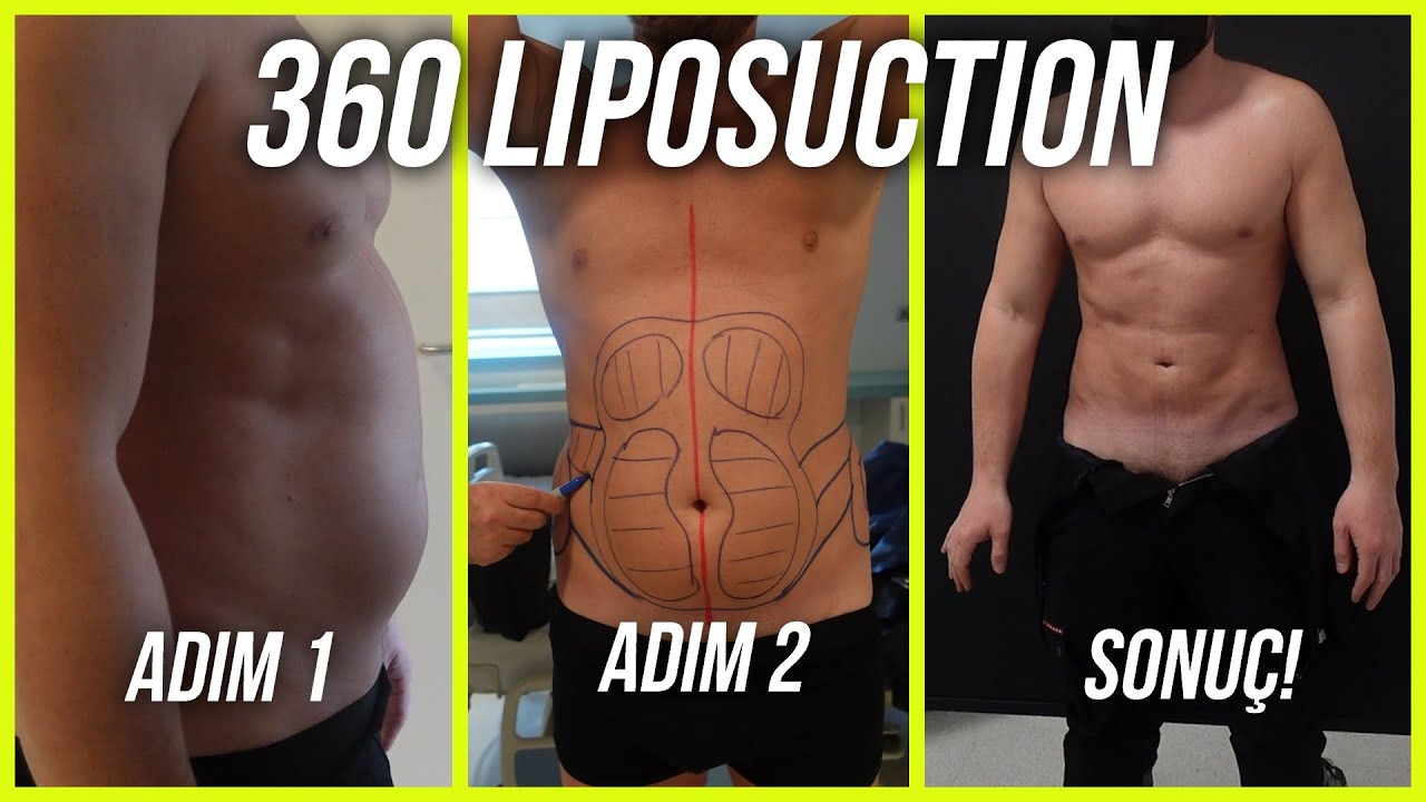 Liposuction in Turkey