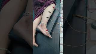 Acupuncture Treatment Leg Pain 