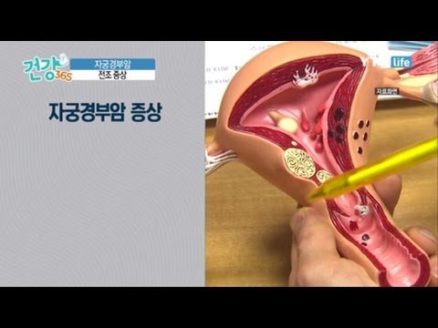 자궁경부암 전조증상 / YTN 라이프