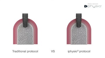 Three-in-one solution  Iphysio is a game changer in implant protocol