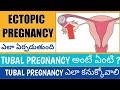 Ectopic Pregnancy and its symtoms in Telugu I Ectopic Pregnancy in Telugu language I Swamy Samudrala
