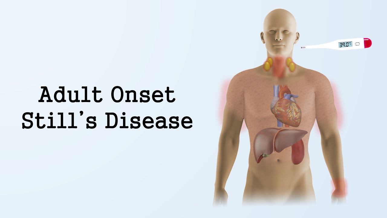 Adult Onset Still's Disease YouTube