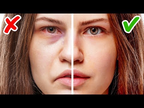 Video: Asymmetrische Augen: Ursachen Und Behandlung