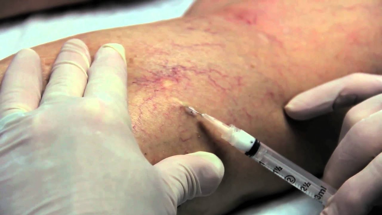 Banner for Sclerotherapy Treatment For Leg Veins in San DIego | Expert Mitchel P. Goldman, MD