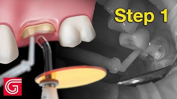 HOW TO Buildup Tooth #14 With Caries BEFORE Preparation