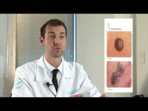 Vídeo: Os melanomas crescem rapidamente?