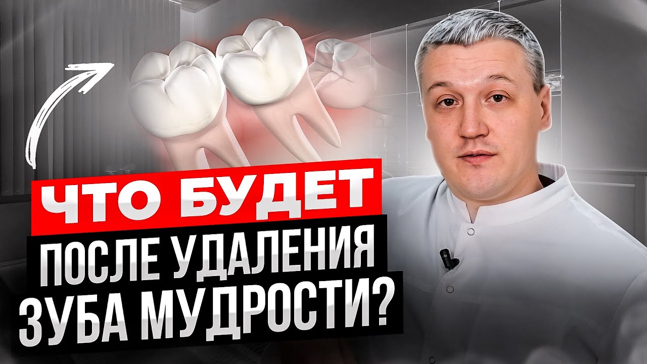 Что будет после удаления зуба мудрости? Рекомендации стоматолога. - YouTube