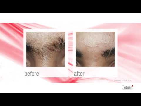 Laser Hair Removal | Salem, OR | Bella Rose Medi Spa