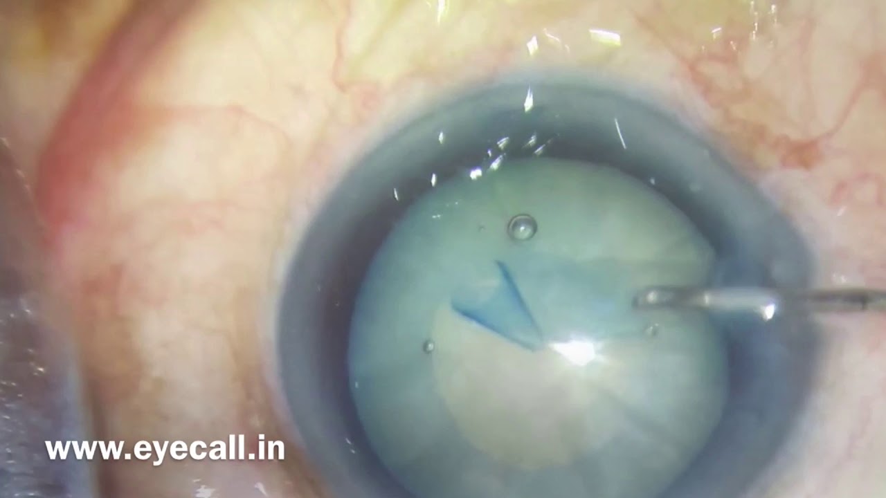 Rhexis is Intumescent Cataract - 3 case series (Rhexis #3) - YouTube