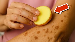 Remove Age Spots in Just 20 Minutes with Potato & Ginger💥(Quick & Easy Remedy)🤯