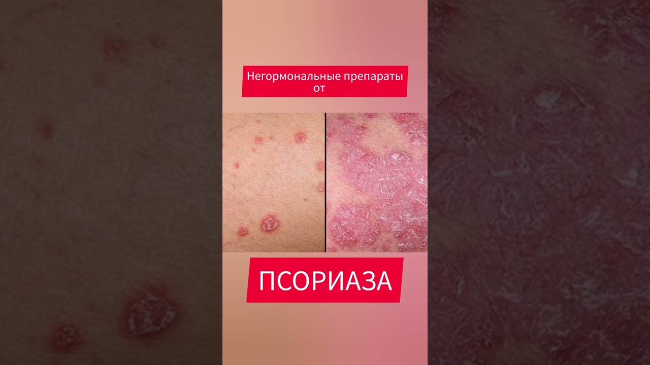 Псориаз. негормональные средства от псориаза. #псориаз #лечениепсориаза