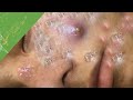 Big pimple acne treatment for truong huu thuong come back from california