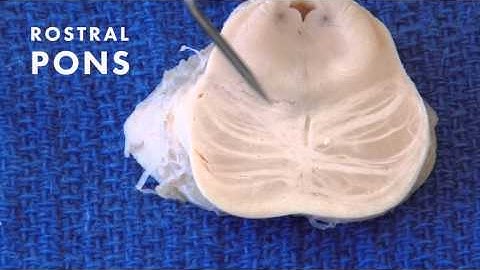 Sensation from the Body: Neuroanatomy Video Lab - Brain Dissections