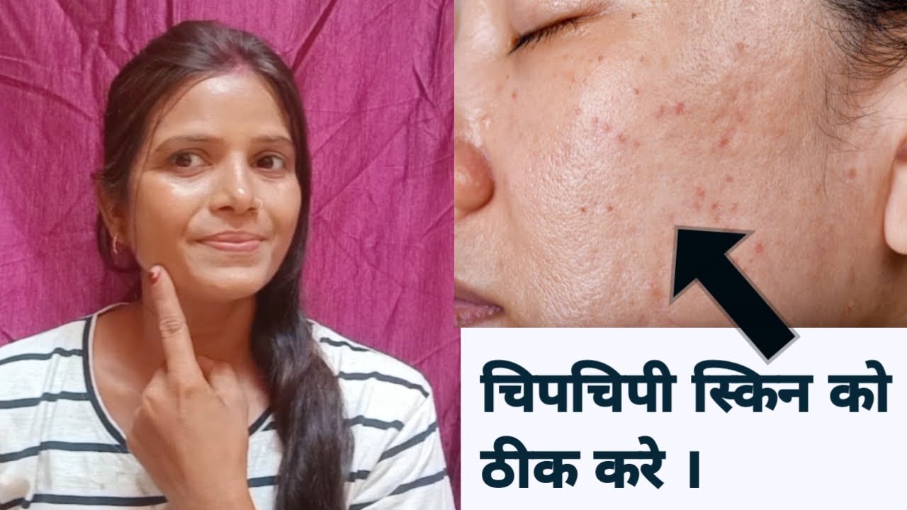 Oily Skin ko Thik kaise karen ? चिपचिपी स्किन से छुटकारा पाए 